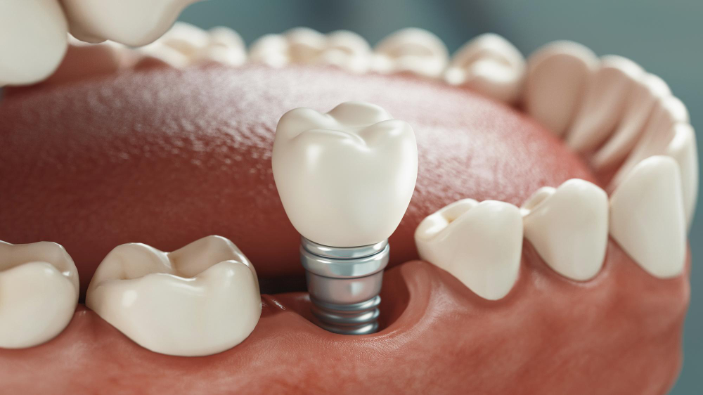 Dental Implants Totowa, NJ