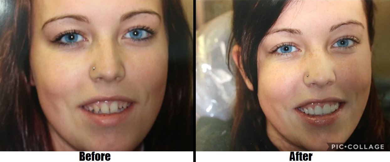 before and after Lumineers smile makeover Totowa, NJ
