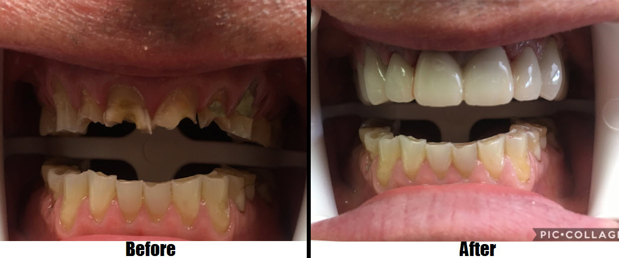 full upper arch porcelain bridge before and after Totowa, NJ