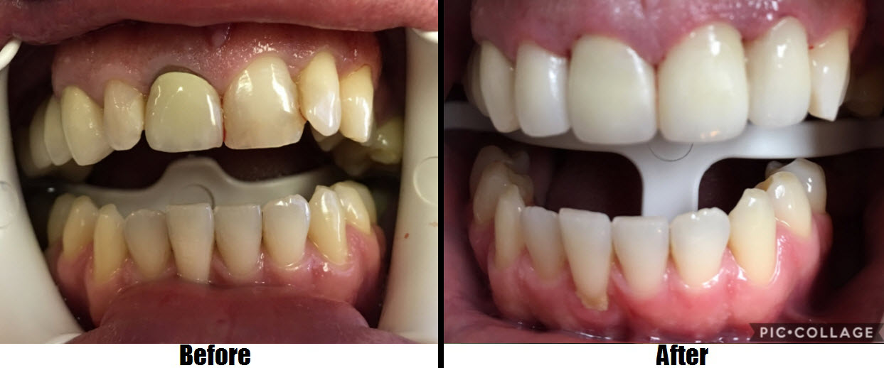 porcelain veneers and crown smile makeover before and after Totowa, NJ