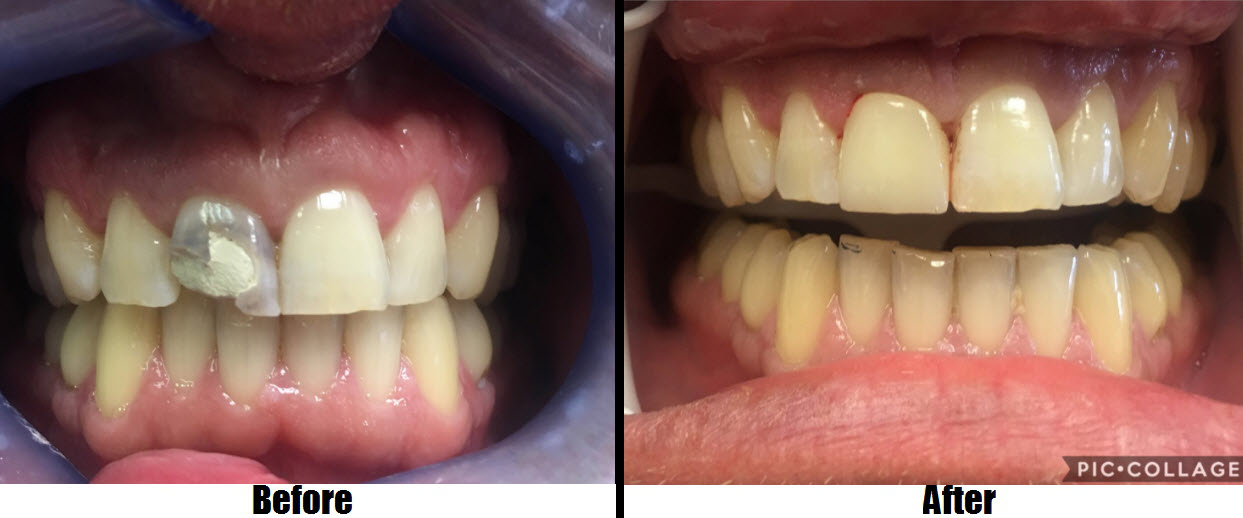 badly broken tooth restored with porcelain crown before and after Totowa, NJ
