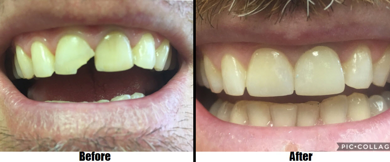broken tooth repaired with porcelain veneer before and after Totowa, NJ